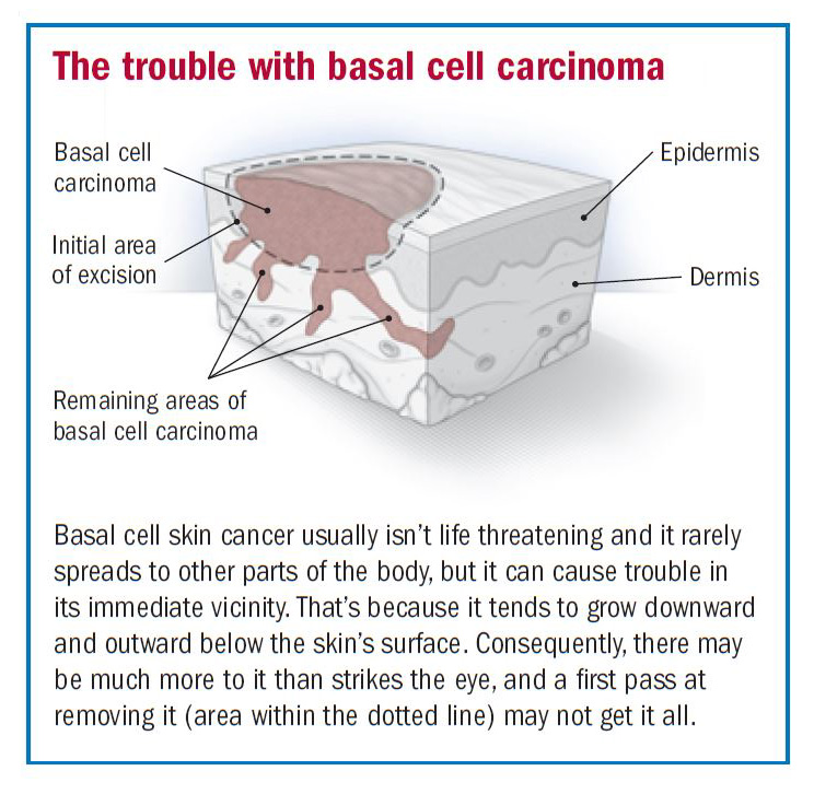 Basal cell carcinoma overview Harvard Health